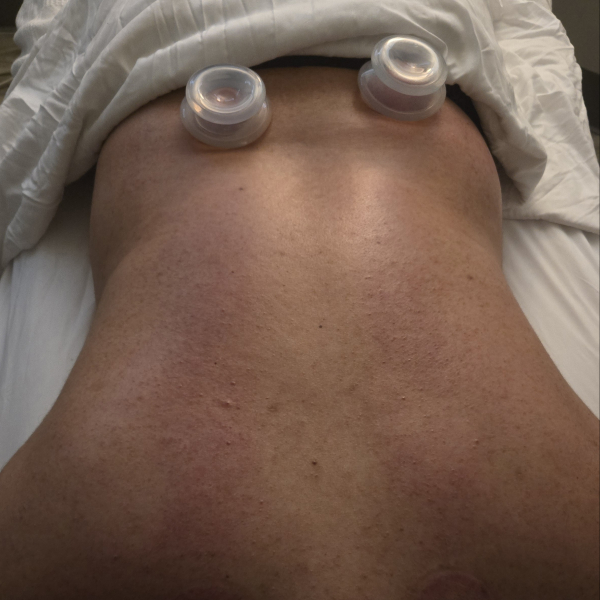 Cupping massage treatment at Yeshua Spa.